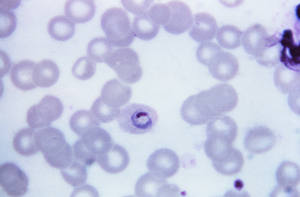Plasmodium ovale Trophozoit im Giemsa-gefärbten Blutausstrich