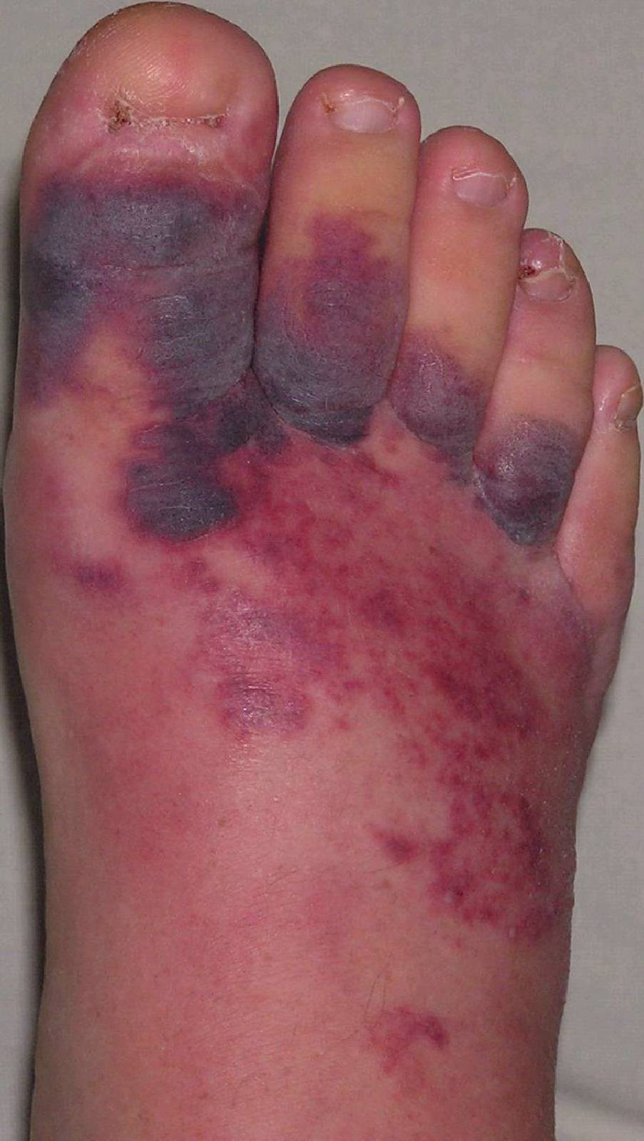 Erysipel