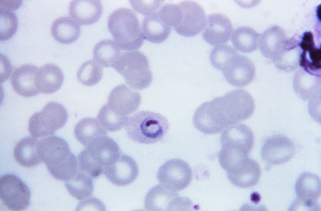 What Is Signet Ring In Malaria What Is Signet Ring In Malaria