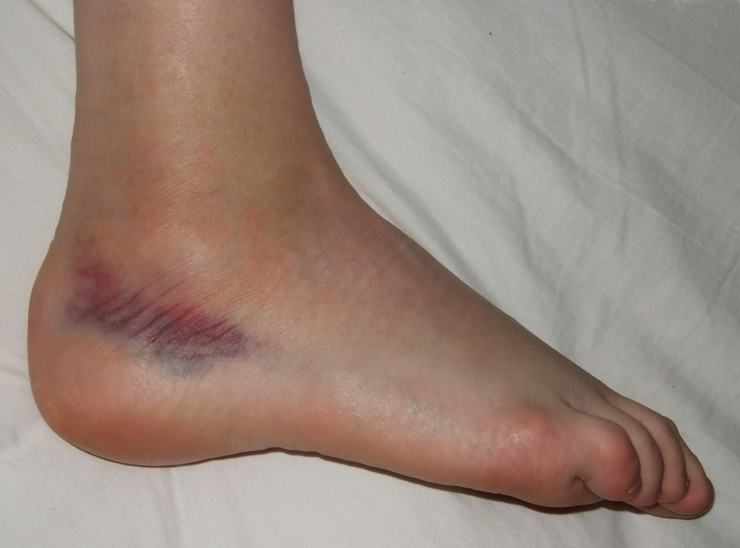 Over Pronation