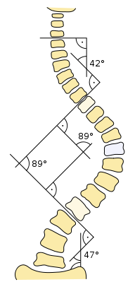 Scoliosis cobb.svg