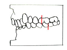 Angle-Klasse II/2