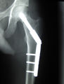 Cdm hip implant 351.jpg