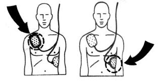 desfibrilador dea externo aed defibrillator defibrillation defibrillateur placement eletrodos elektroden electrode automtico 3eme externer automatisierter defib rcp werthenbach dewiki