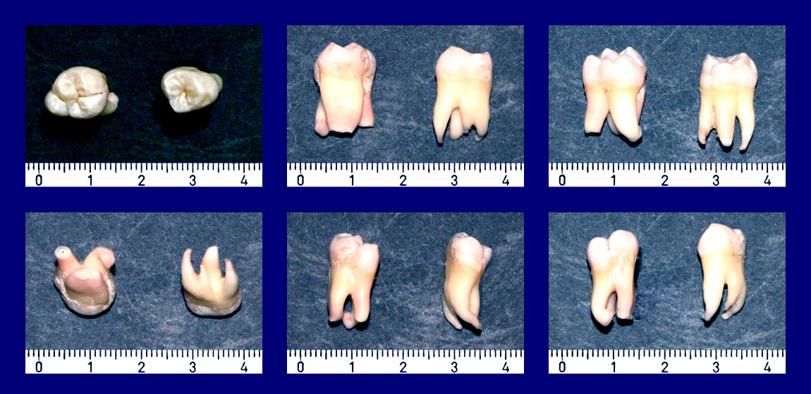 Зуб семерка верхний. Резцы клыки премоляры моляры анатомия. Молочный моляр верхней челюсти. Молочный премоляр верхней челюсти.